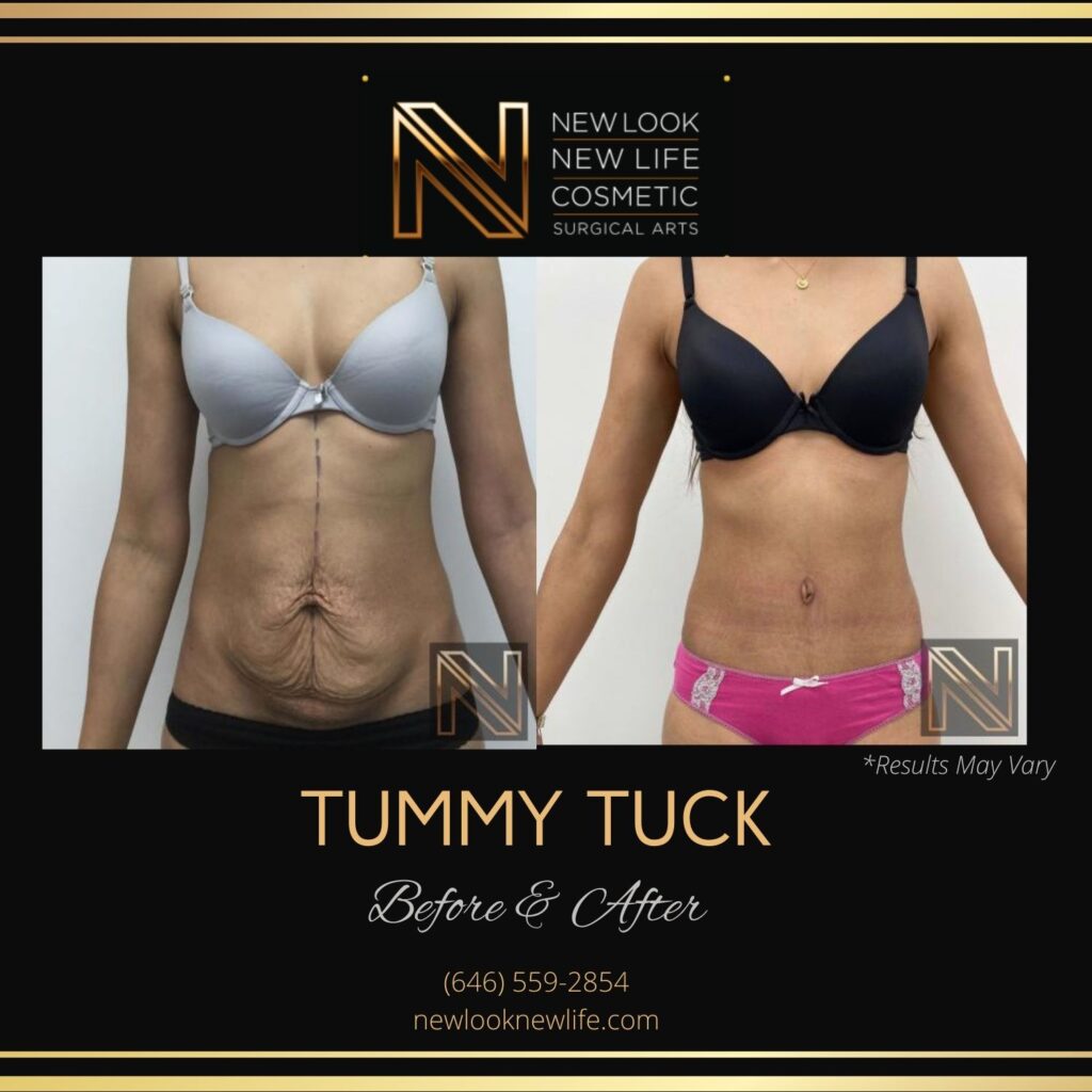 Before and after image showing the results of a tummy tuck performed in New York, NY.